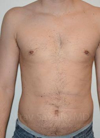 Male Breast Reduction Before & After Gallery - Patient 1655612 - After