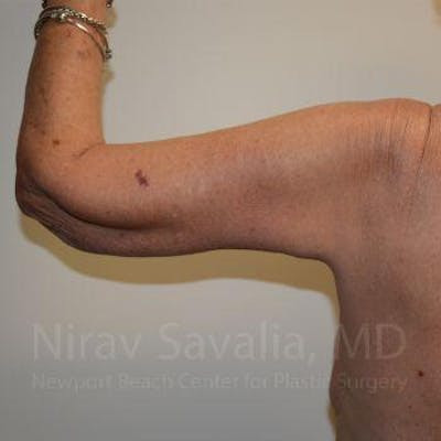 Arm Lift Before & After Gallery - Patient 1655610 - After