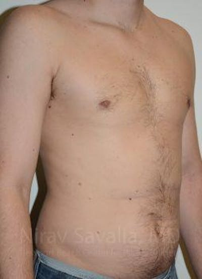 Abdominoplasty Tummy Tuck Before & After Gallery - Patient 1655612 - After