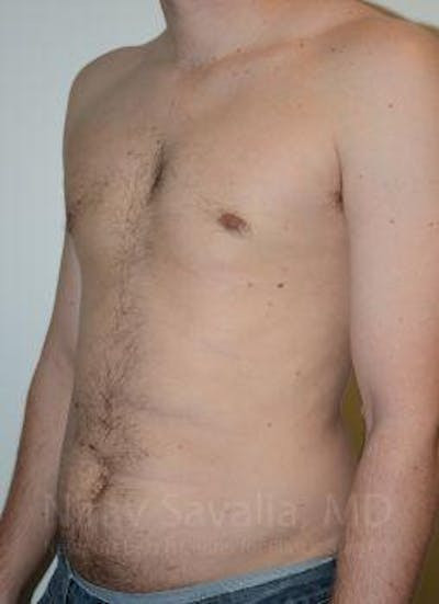 Male Breast Reduction Before & After Gallery - Patient 1655612 - After