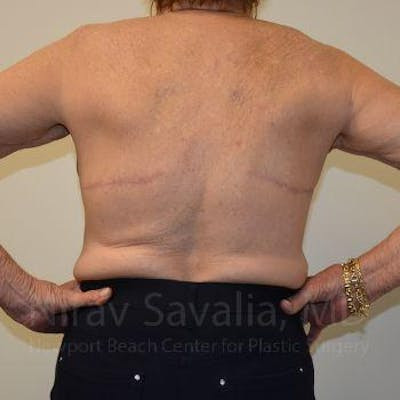 Body Contouring after Weight Loss Before & After Gallery - Patient 1655616 - After