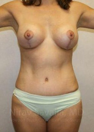 Breast Reduction Before & After Gallery - Patient 1655621 - After