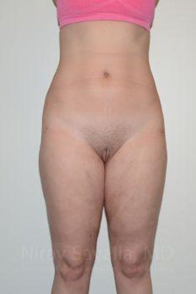 Liposuction Before & After Gallery - Patient 1655629 - After