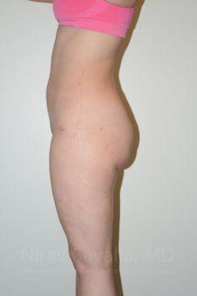 Liposuction Before & After Gallery - Patient 1655629 - After