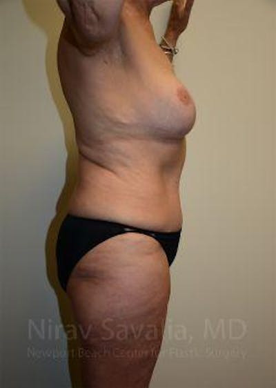 Abdominoplasty Tummy Tuck Before & After Gallery - Patient 1655634 - After