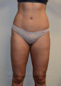 Liposuction Before & After Gallery - Patient 1655642 - Image 2