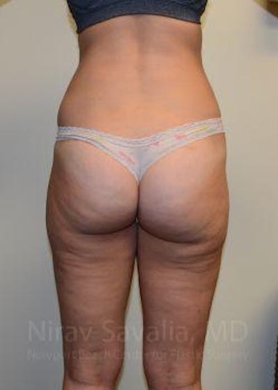 Liposuction Before & After Gallery - Patient 1655642 - After