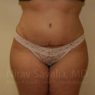 Liposuction Before & After Gallery - Patient 1655647 - After