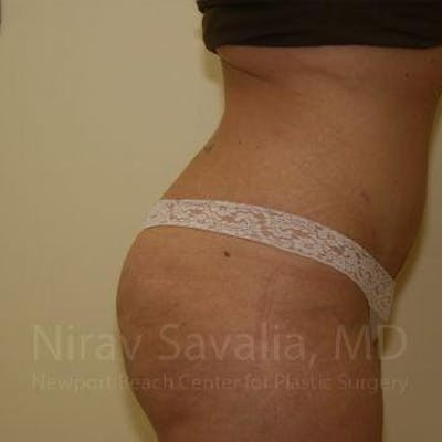 Liposuction Before & After Gallery - Patient 1655647 - After