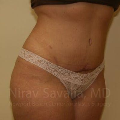 Liposuction Before & After Gallery - Patient 1655647 - After