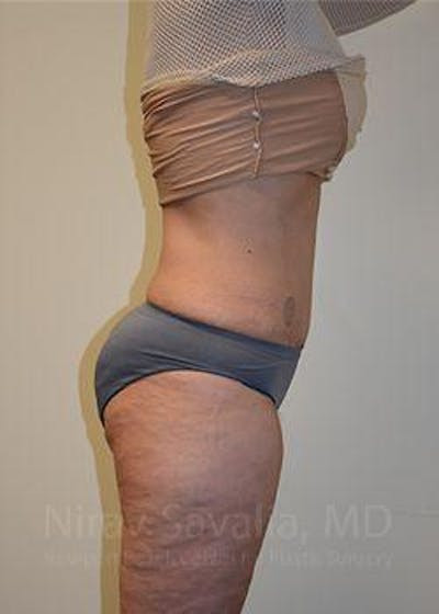 Liposuction Before & After Gallery - Patient 1655654 - After