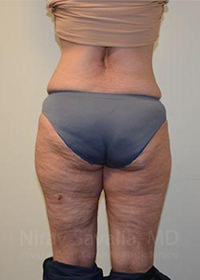 Liposuction Before & After Gallery - Patient 1655654 - After