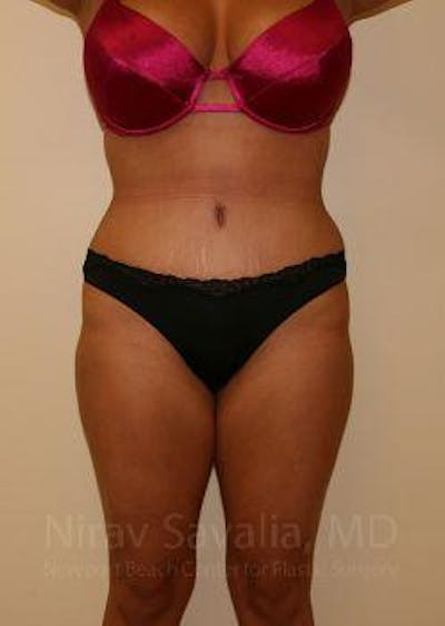 Liposuction Before & After Gallery - Patient 1655656 - After