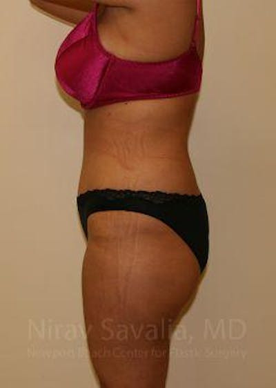 Liposuction Before & After Gallery - Patient 1655656 - After