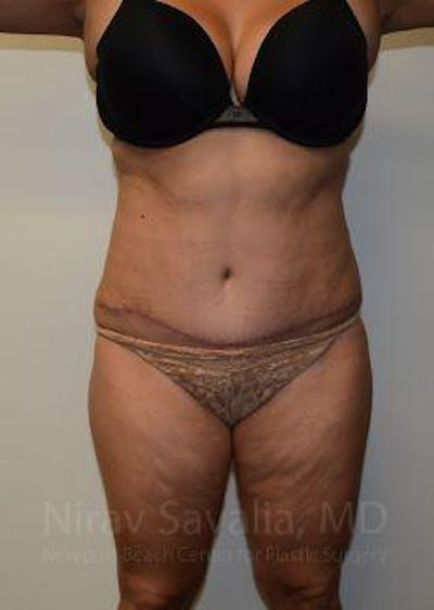 Fat Grafting to Face Before & After Gallery - Patient 1655659 - After