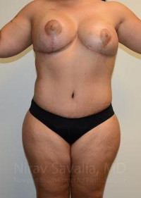 Liposuction Before & After Gallery - Patient 1655660 - Image 2