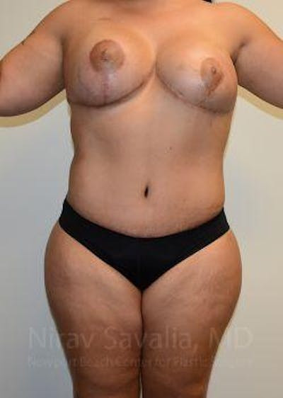 Liposuction Before & After Gallery - Patient 1655660 - After