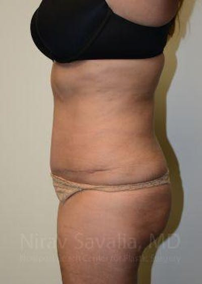 Abdominoplasty Tummy Tuck Before & After Gallery - Patient 1655659 - After