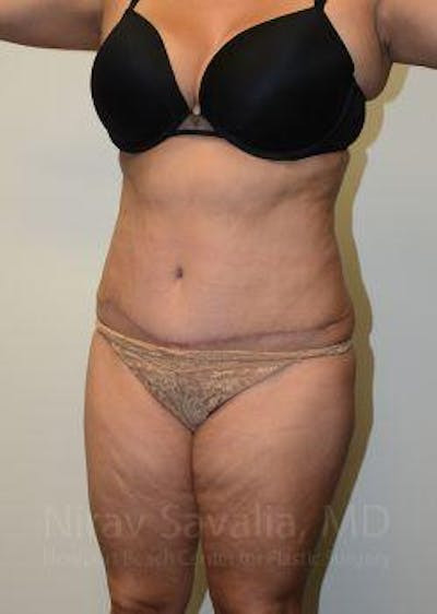 Abdominoplasty Tummy Tuck Before & After Gallery - Patient 1655659 - After