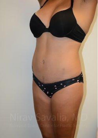 Breast Reduction Before & After Gallery - Patient 1655662 - After