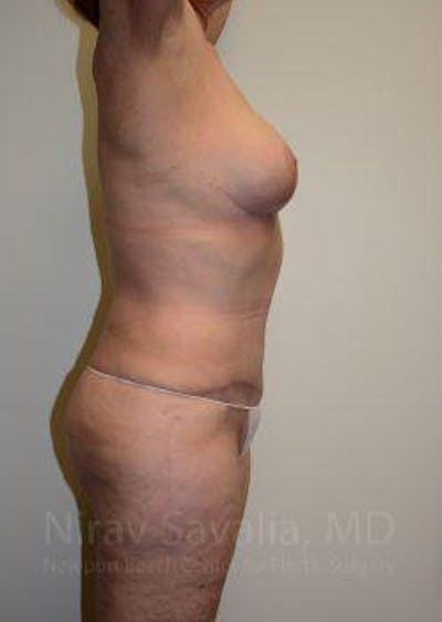 Fat Grafting to Face Before & After Gallery - Patient 1655663 - After