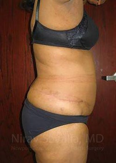 Abdominoplasty Tummy Tuck Before & After Gallery - Patient 1655665 - After