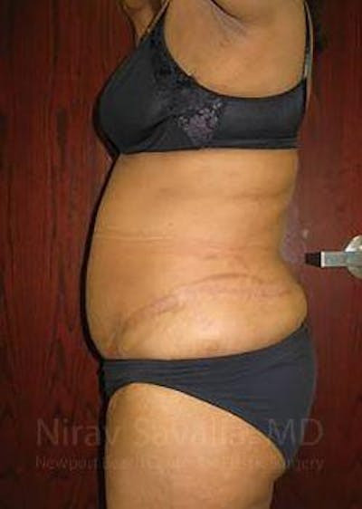 Abdominoplasty Tummy Tuck Before & After Gallery - Patient 1655665 - After