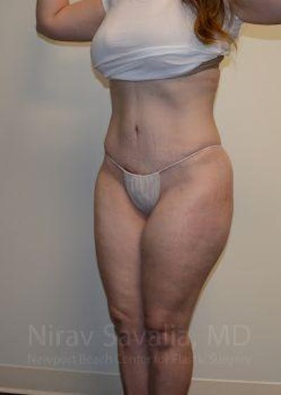 Abdominoplasty Tummy Tuck Before & After Gallery - Patient 1655670 - After