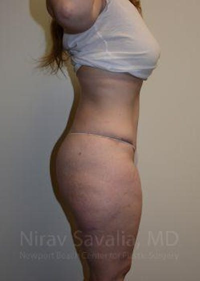 Abdominoplasty Tummy Tuck Before & After Gallery - Patient 1655670 - After