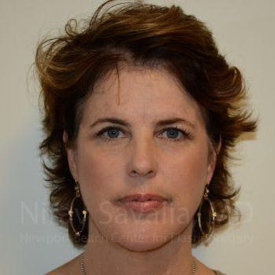 Fat Grafting to Face Before & After Gallery - Patient 1655683 - After