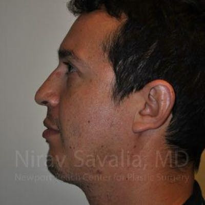 Fat Grafting to Face Before & After Gallery - Patient 1655678 - After