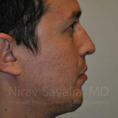 Fat Grafting to Face Before & After Gallery - Patient 1655678 - After