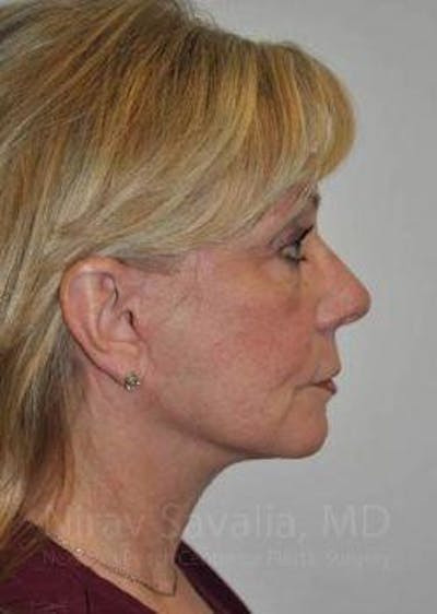 Facelift Before & After Gallery - Patient 1655682 - After