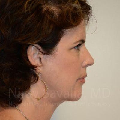 Eyelid Surgery Before & After Gallery - Patient 1655683 - After