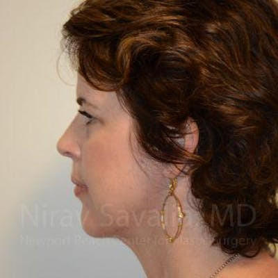 Fat Grafting to Face Before & After Gallery - Patient 1655683 - After