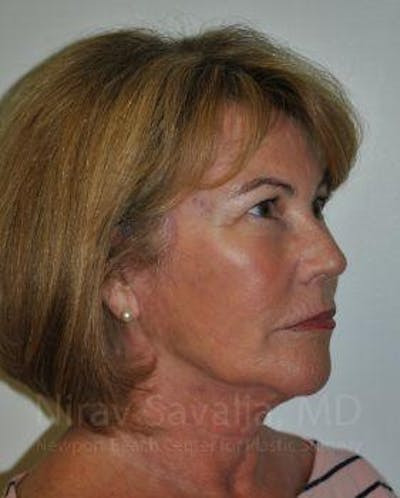 Brow Lift Before & After Gallery - Patient 1655680 - After