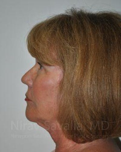 Brow Lift Before & After Gallery - Patient 1655680 - After