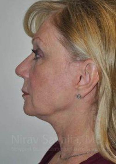 Fat Grafting to Face Before & After Gallery - Patient 1655681 - After