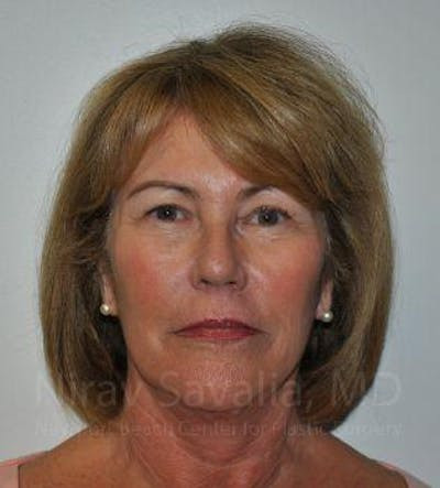 Facelift Before & After Gallery - Patient 1655695 - After