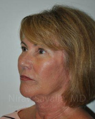 Fat Grafting to Face Before & After Gallery - Patient 1655695 - After