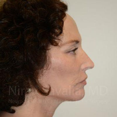 Fat Grafting to Face Before & After Gallery - Patient 1655693 - After