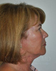 https://newportbeachcosmeticsurgeons.triplenerdscore.xyz/gallery-images/1572057518-b88c2a29-80d6-424e-9e6b-859edc3ff92e.jpg