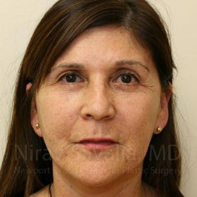 Breast Reduction Before & After Gallery - Patient 1655702 - After