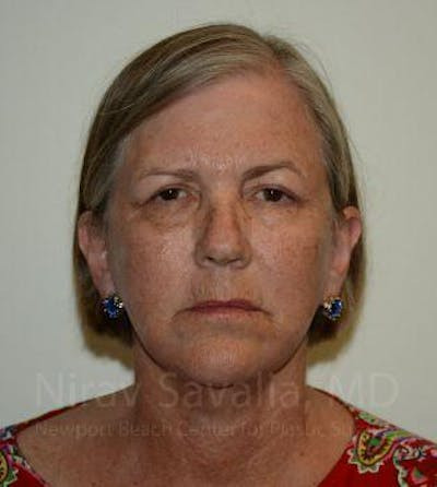 Eyelid Surgery Before & After Gallery - Patient 1655699 - After