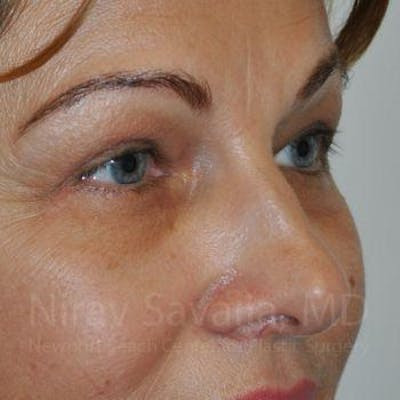 Eyelid Surgery Before & After Gallery - Patient 1655701 - After