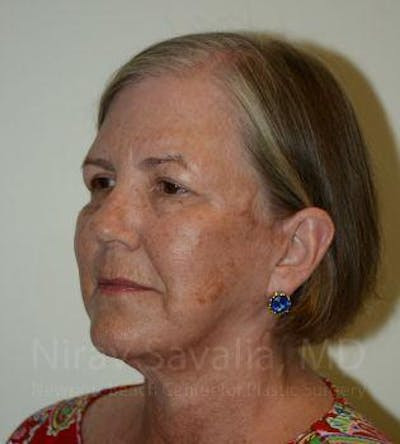 Facelift Before & After Gallery - Patient 1655699 - After