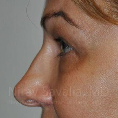 Eyelid Surgery Before & After Gallery - Patient 1655701 - After