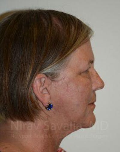 Facelift Before & After Gallery - Patient 1655699 - After