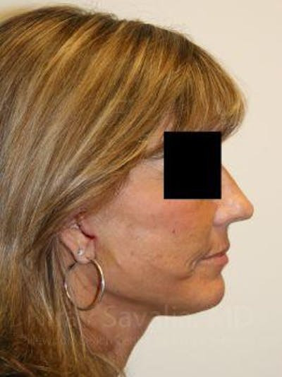 Facelift Before & After Gallery - Patient 1655704 - After