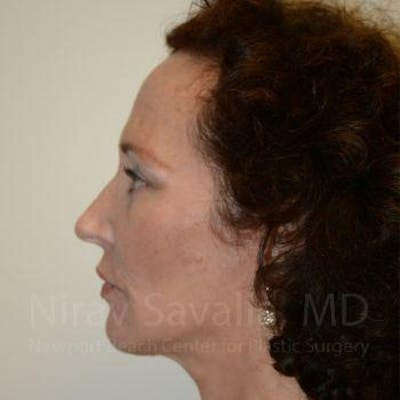 Breast Lift without Implants Before & After Gallery - Patient 1655712 - After